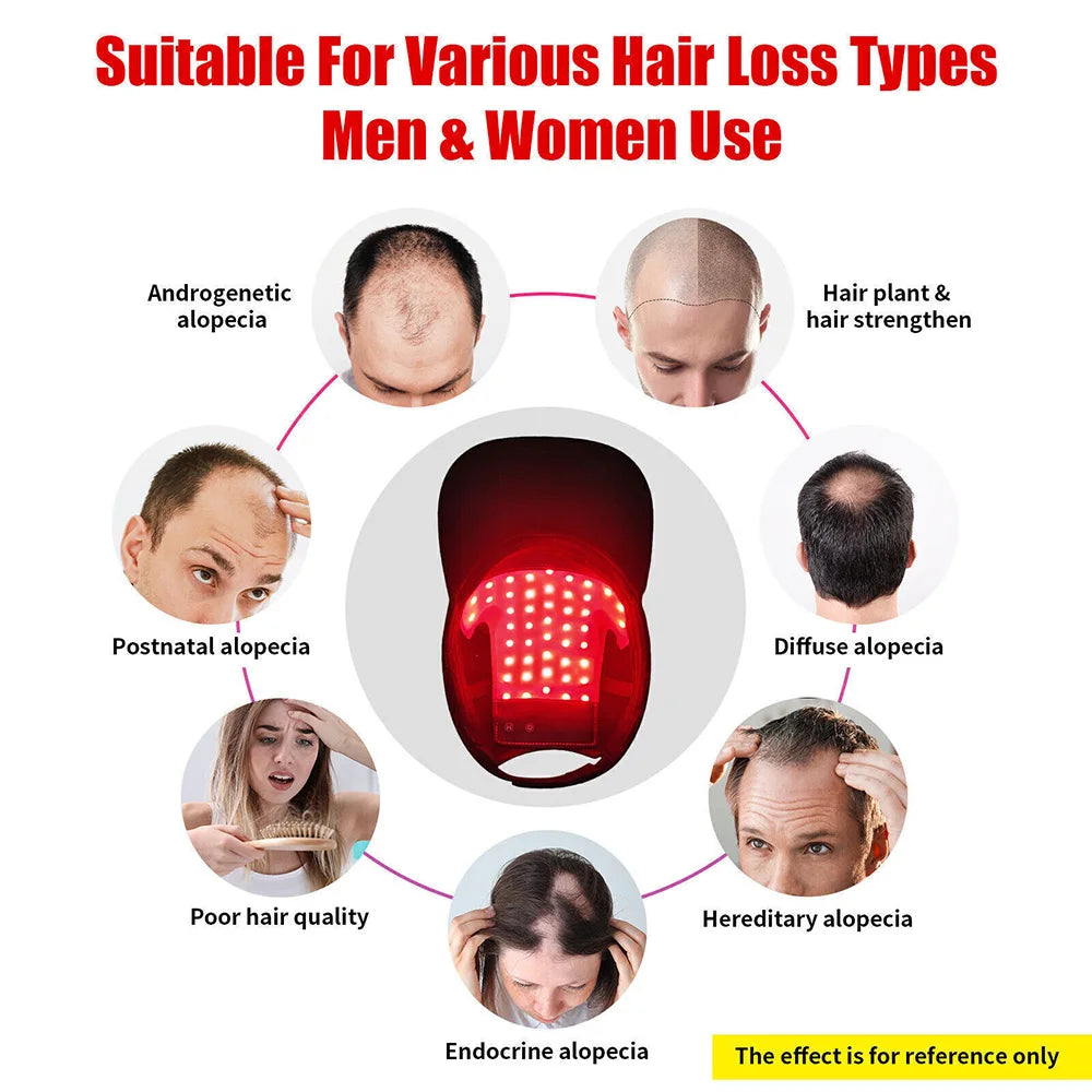 Infrared Red Light Therapy Cap Hair Regrowth Treatment Hat For Hair Regrowth Hair growth Anti-Hair Loss - Scalpx