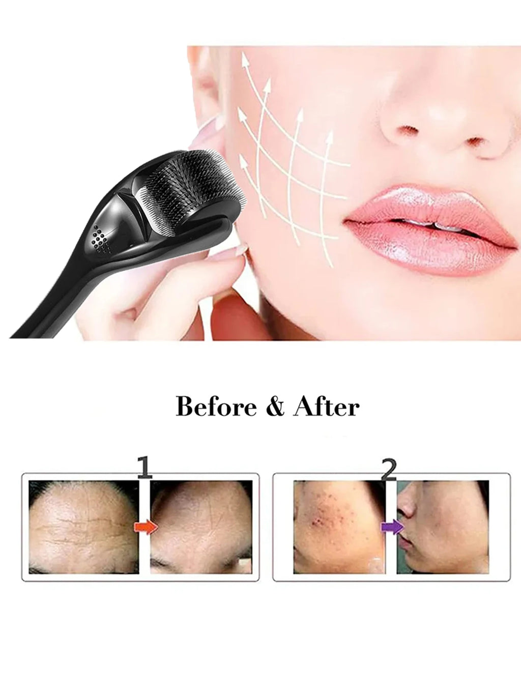 Derma Microneedling Roller with Titanium Needles - Scalpx