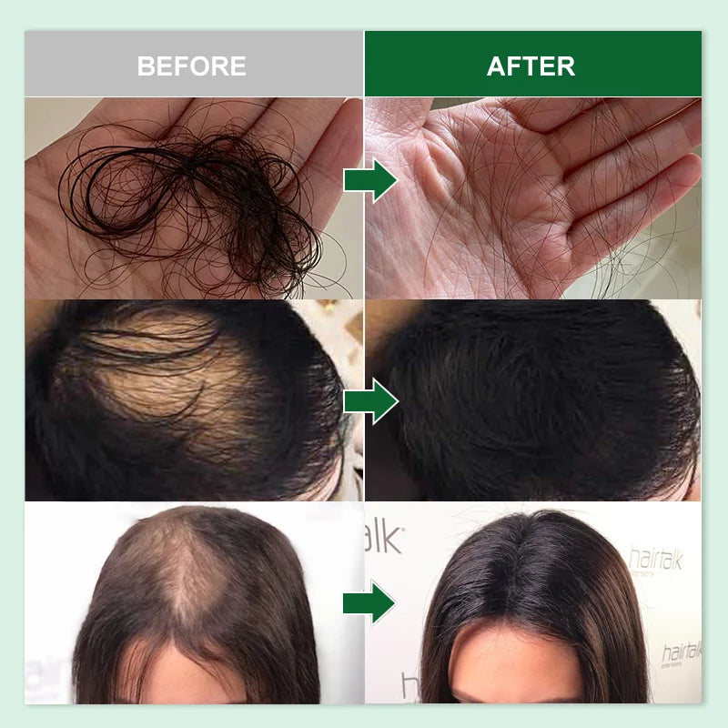 Rosemary Oil Hair Growth Products for Man - Women | Anti Hair Loss Fast Regrowth Thicken Oils Scalp Treatment Hair Care - Scalpx